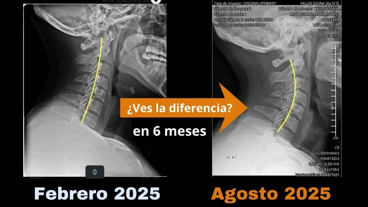 Radiografía cambio 6 meses - Andrés Tapia