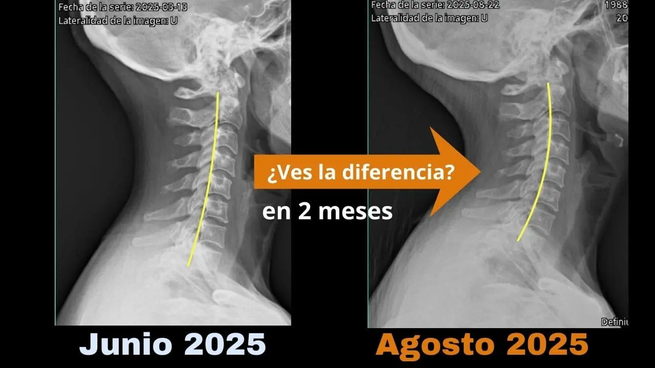 Radiografía cambio 2 meses - Ale Rodriguez