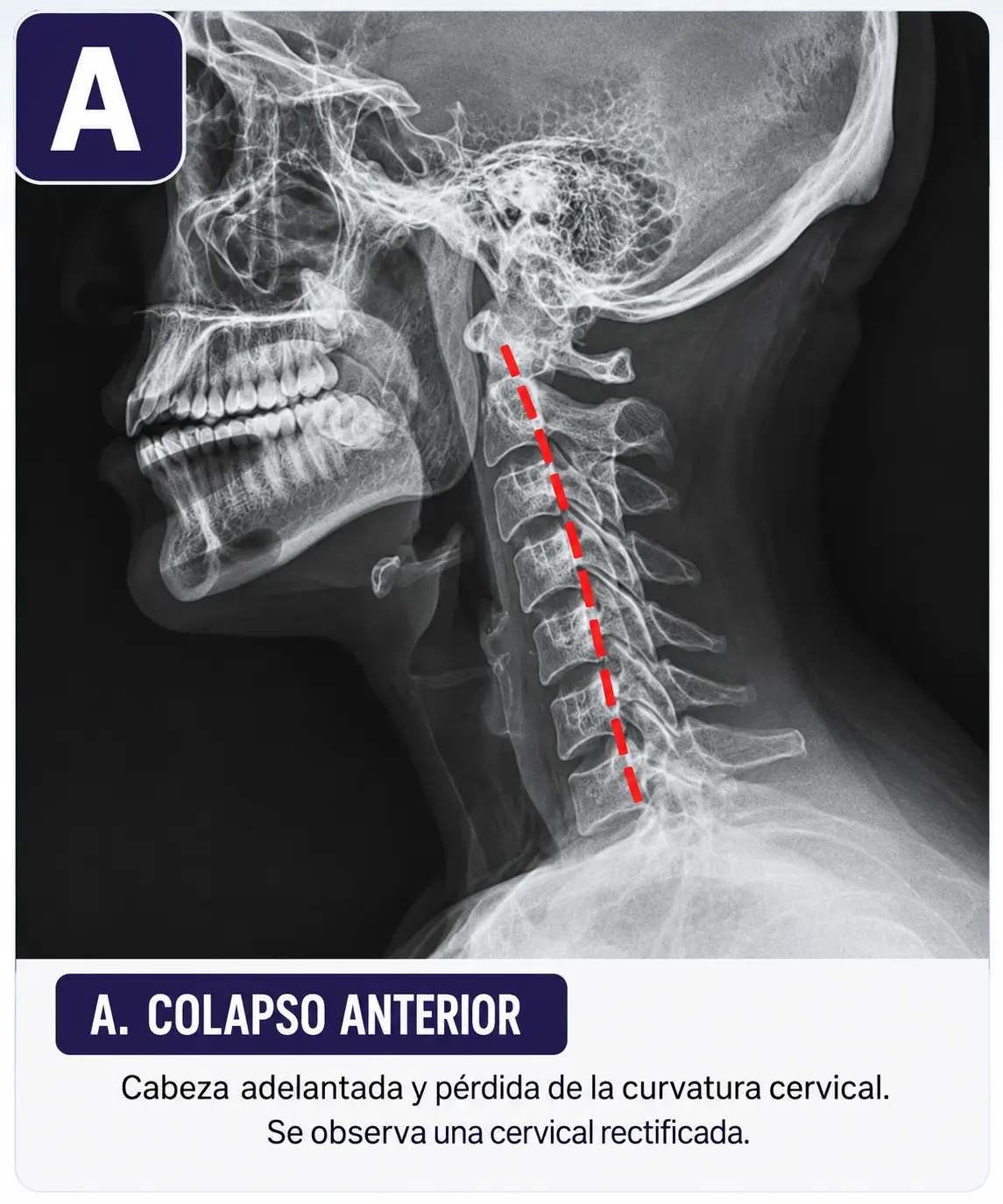 Cervical con cabeza adelantada