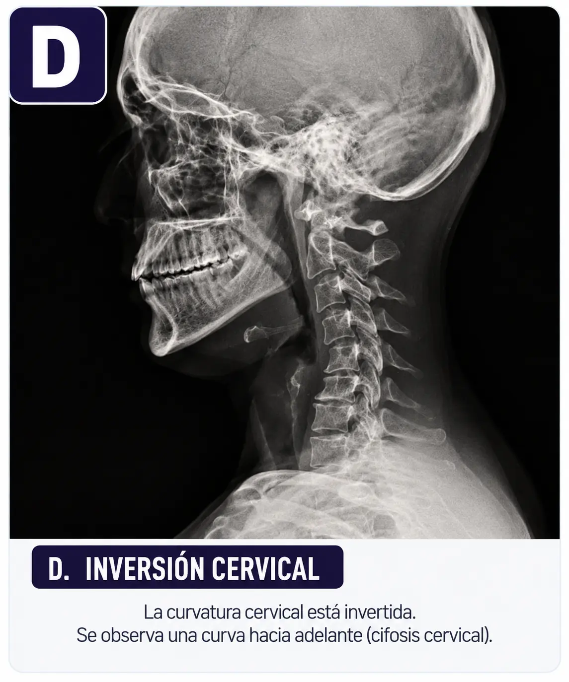 Cervical con morfología invertida