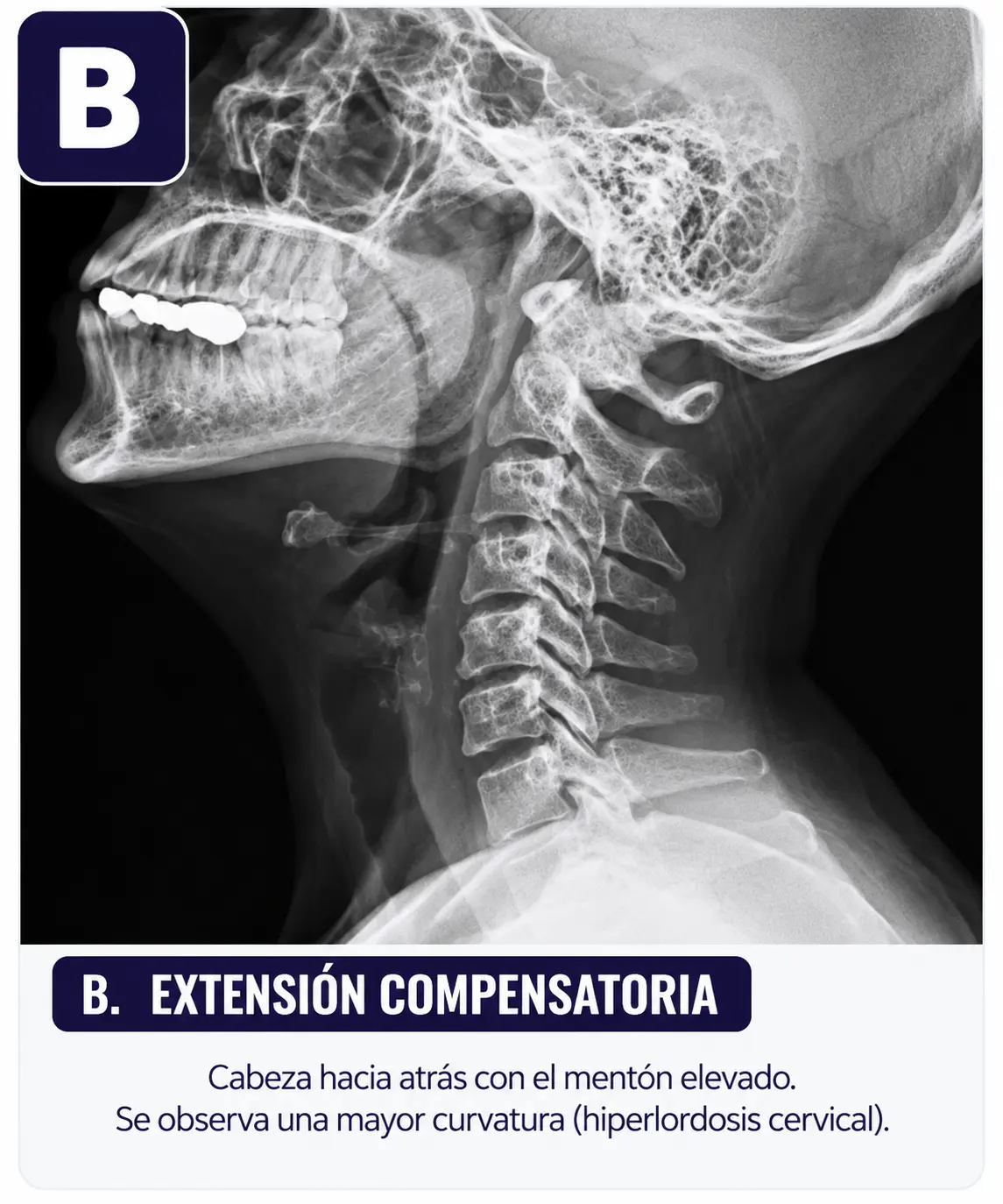 Cervical con mentón elevado