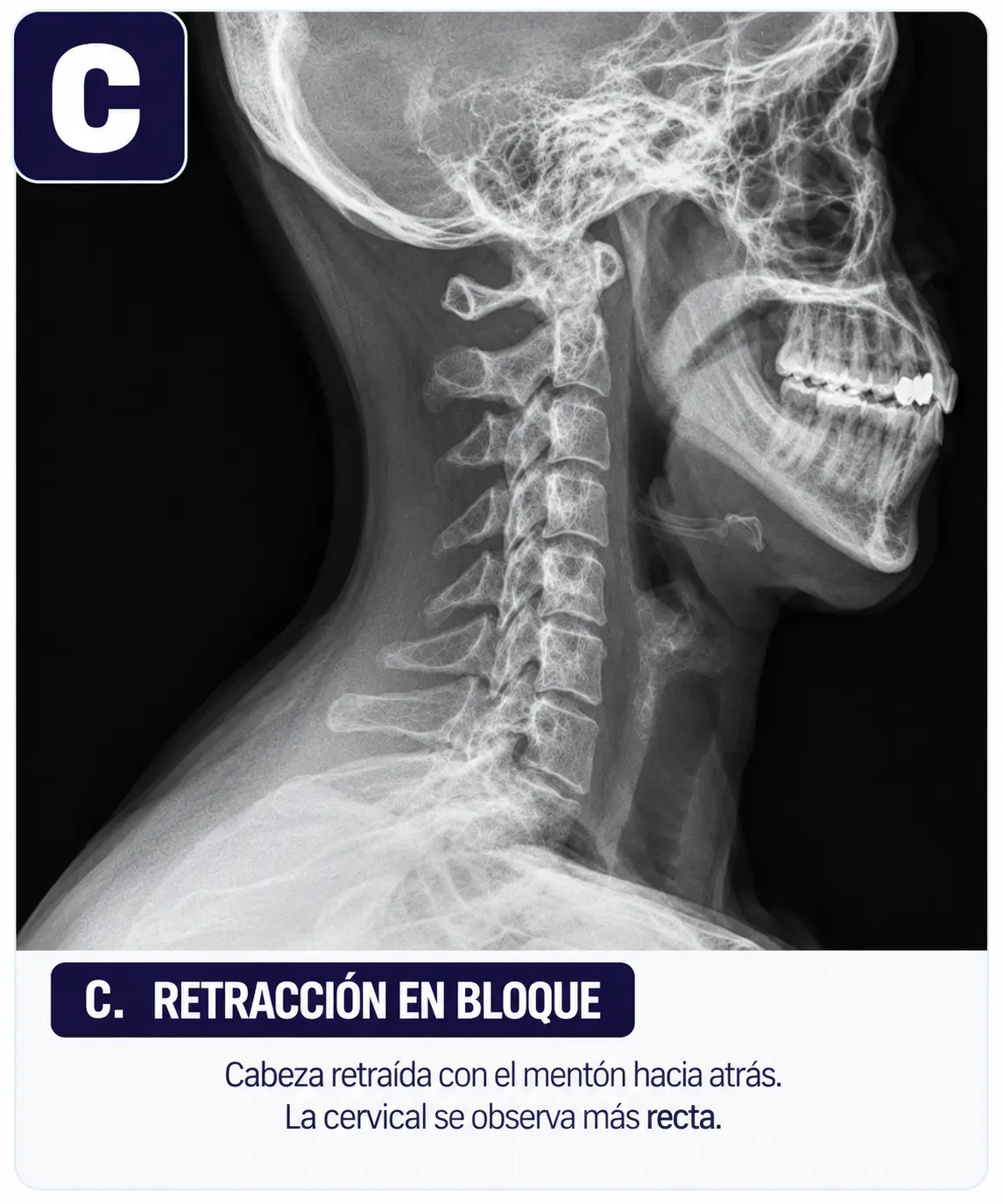 Cervical con mentón retraído